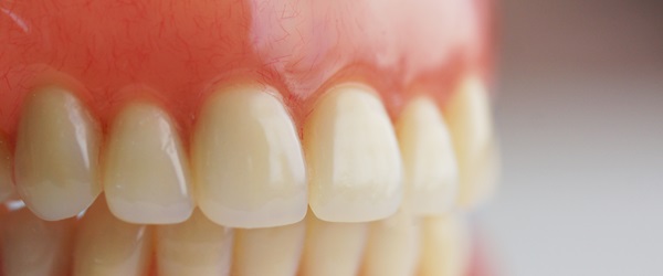 Replacing of missing teeth
