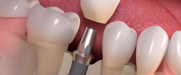 Dental Implants