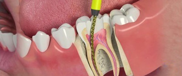 Root canal treatment (RCT)