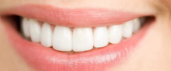 Veneers/Hollywood Smile